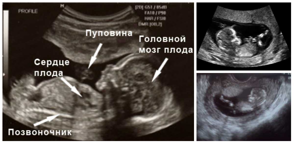 13 неделя беременности - мапапама.ру — сайт для будущих и молодых родителей: беременность и роды, уход и воспитание детей до 3-х лет