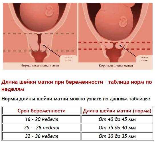 Цервикометрия при беременности