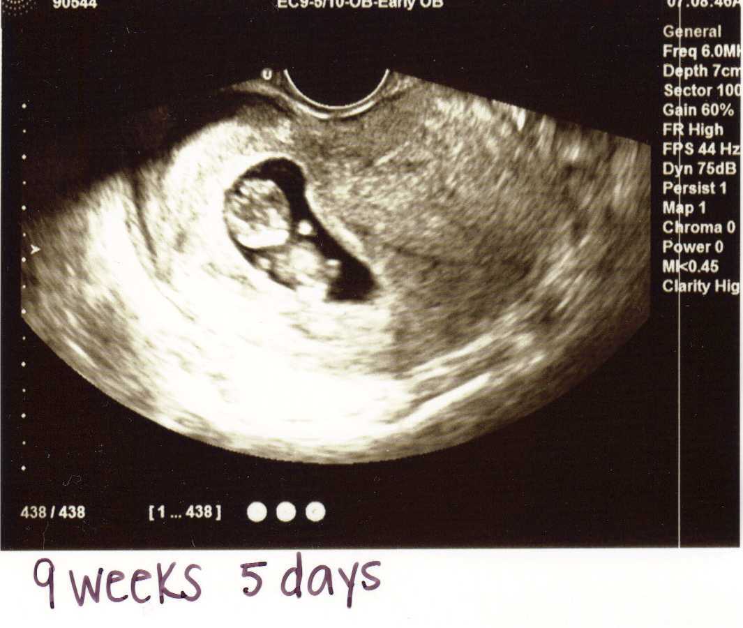 Узи на 8 неделе беременности: фото, показатели, нормы