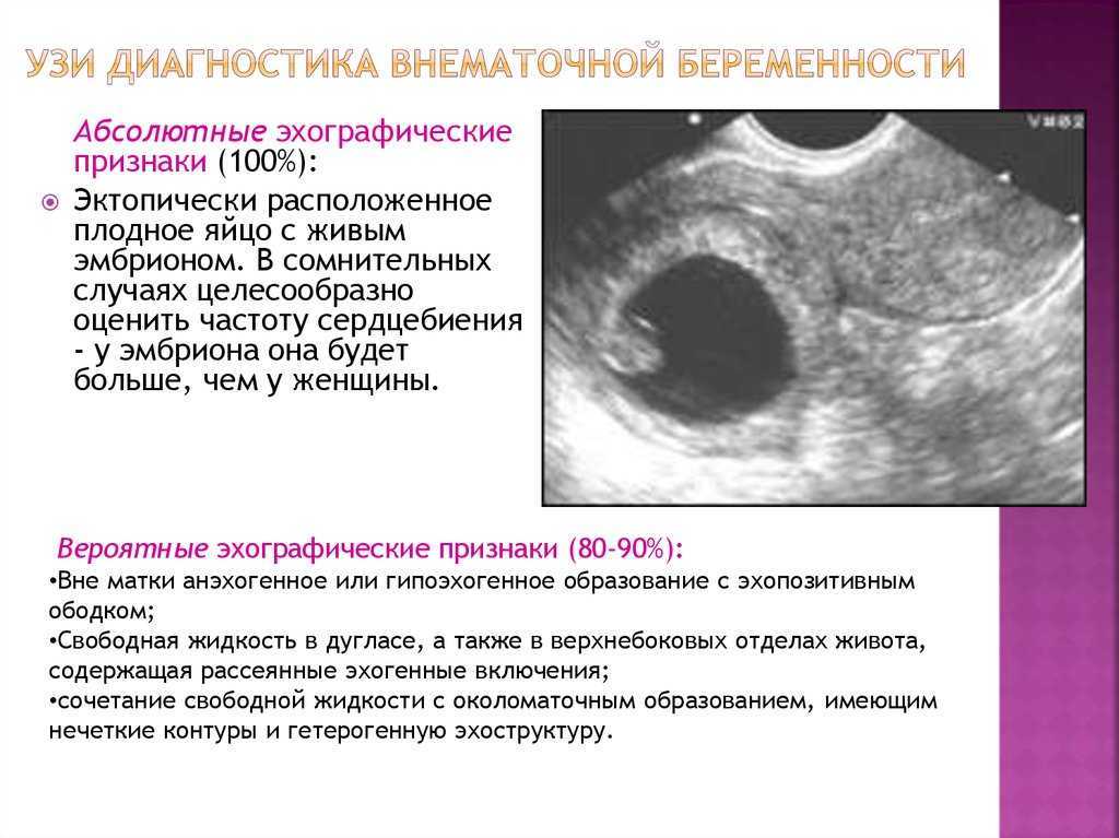 Внематочная (эктопическая) беременность: что это и как быть