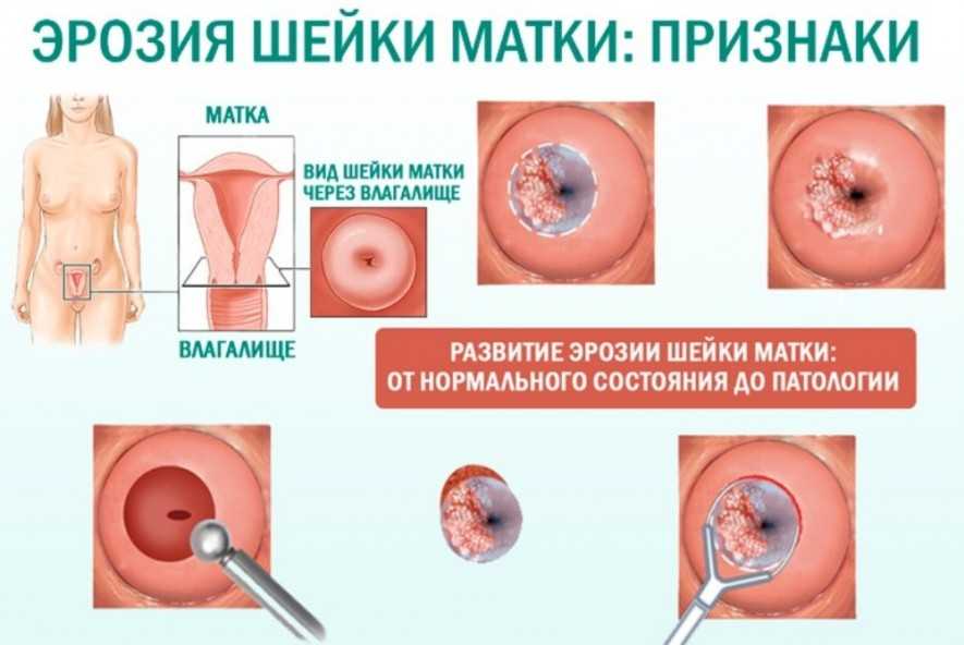 Рак шейки матки: симптомы и признаки на ранней стадии, лечение онкологии шейки матки у женщин, прогноз | клиники «евроонко»