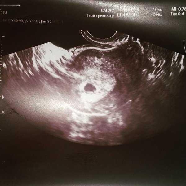 Узи 2 недели беременности: фото, что покажет исследование и можно ли увидеть эмбрион