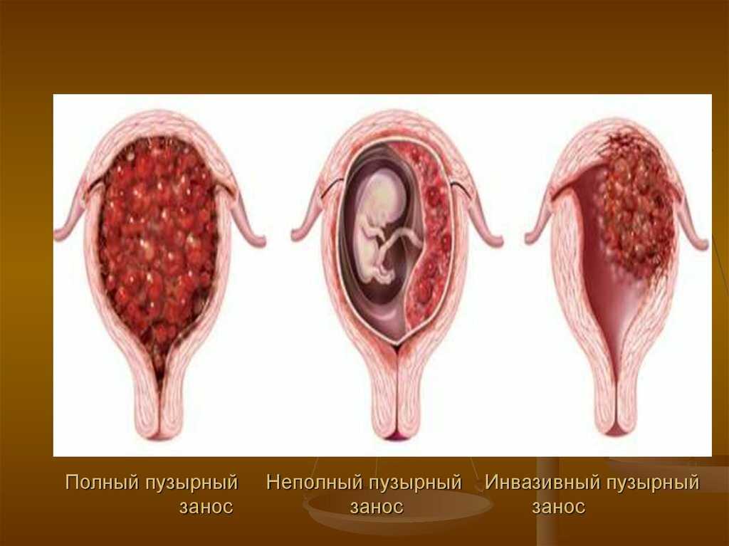 Чечнева м.а. • мезенхимальная дисплазия плаценты - пренатальная диагностика (клинические наблюдения)