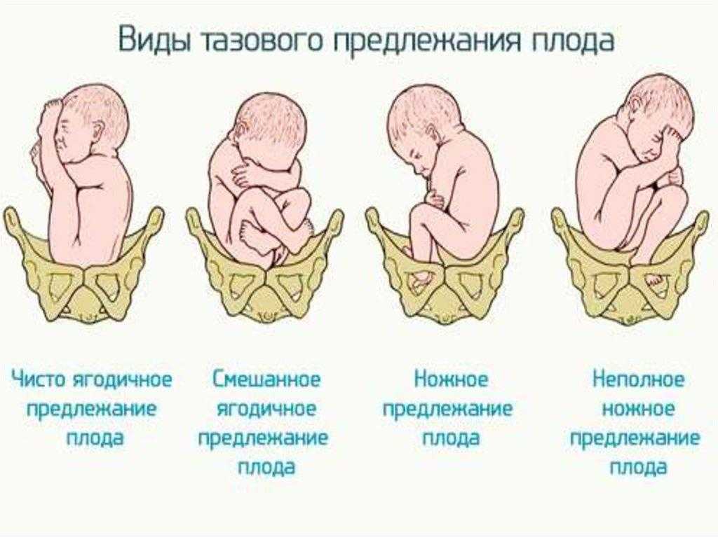 Причины крупного плода при беременности, диагностика и сопутствующие признаки, возможные последствия и течение родов