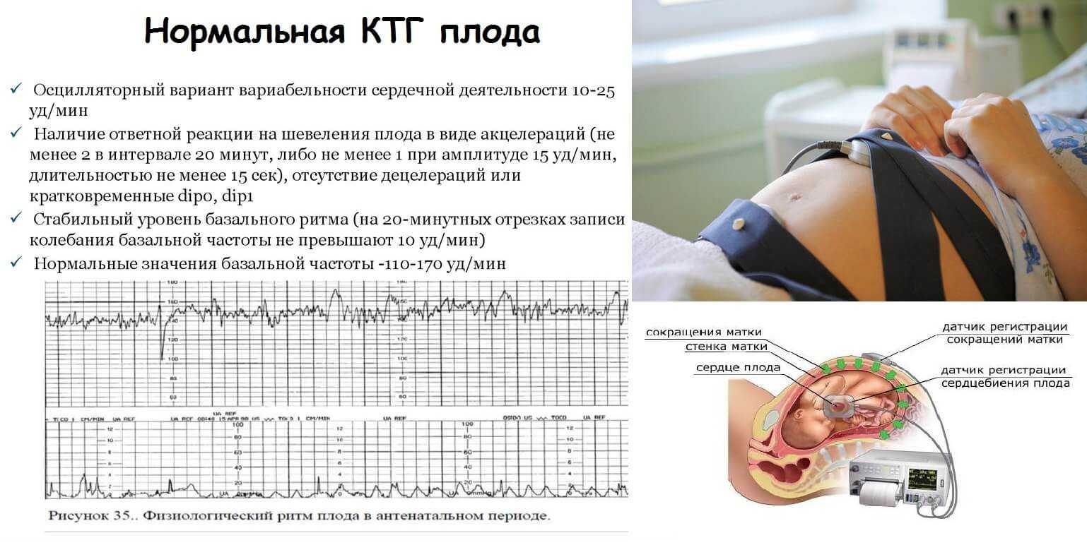 Беременность и кардиоваскулярная патология