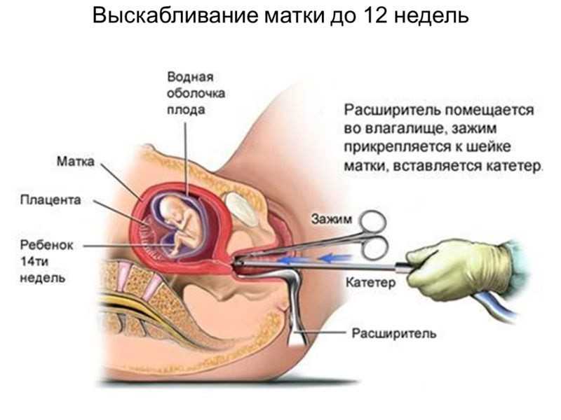 Выскабливание при замершей беременности полости матки: ход процедуры, возможные осложнения