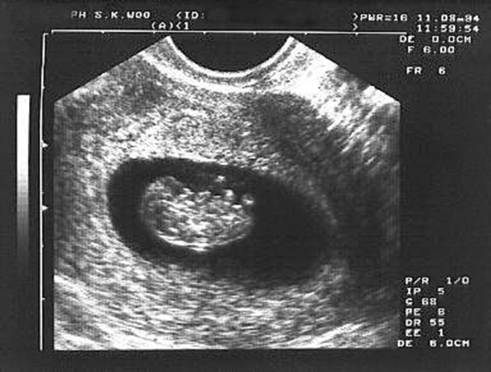 8 неделя беременности: развитие плода, фото живота, узи