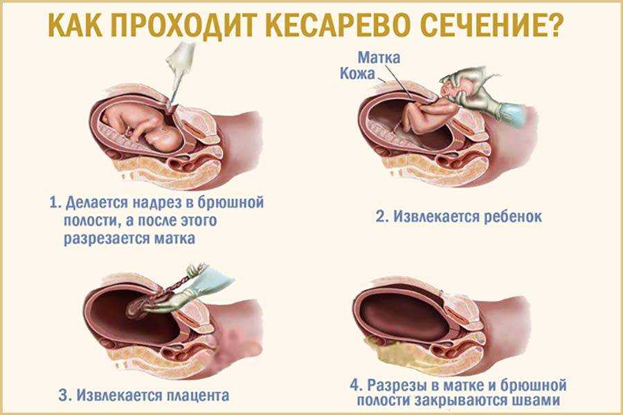 Повторная операция кесарева сечения у женщин с двумя и более рубцами на матке | яметова | медицинский вестник юга россии