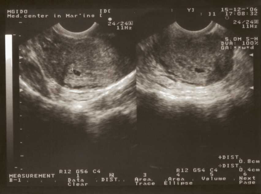 3 неделя беременности что происходит с эмбрионом, признаки беременности, симптомы, боли в животе