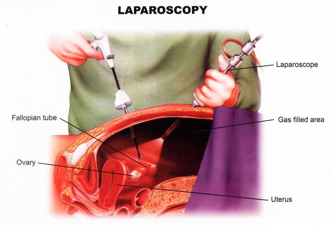 Беременность после лапароскопии наступает с высокой долей вероятности Главное, чтобы операция прошла успешно