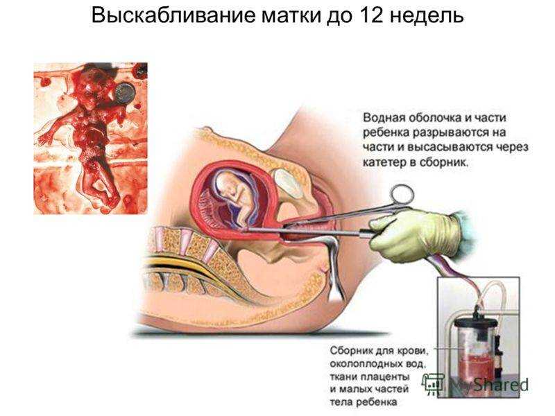 Выскабливание полипа и замершей беременности