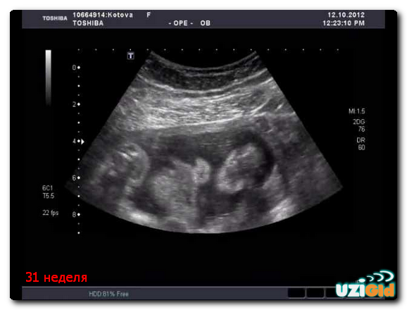 31 неделя беременности развитие и фото — евромедклиник 24