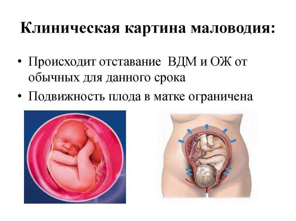 Маловодие при беременности: причины и последствия, чем опасно, лечение - medside.ru
