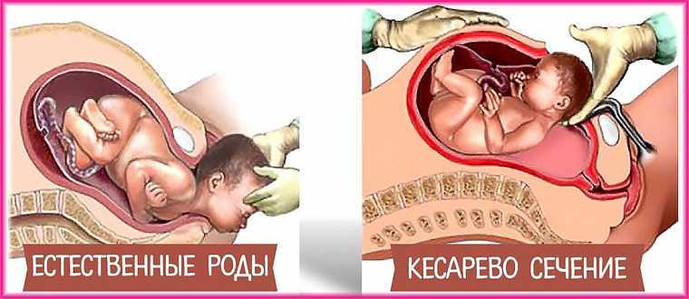 Особенности беременности и родов при рубце на матке после кесарева сечения