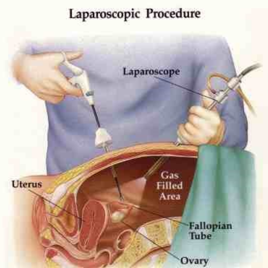 Лапароскопия матки и придатков: виды, показания для процедуры | food and health
