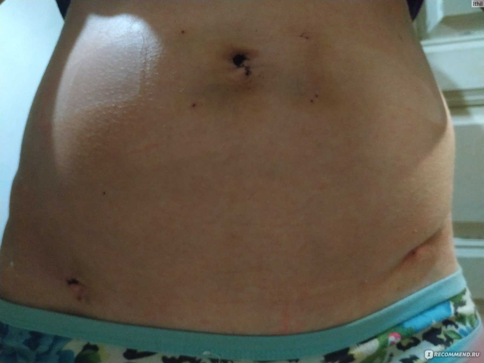 Беременность после лапароскопии: через сколько можно зачать