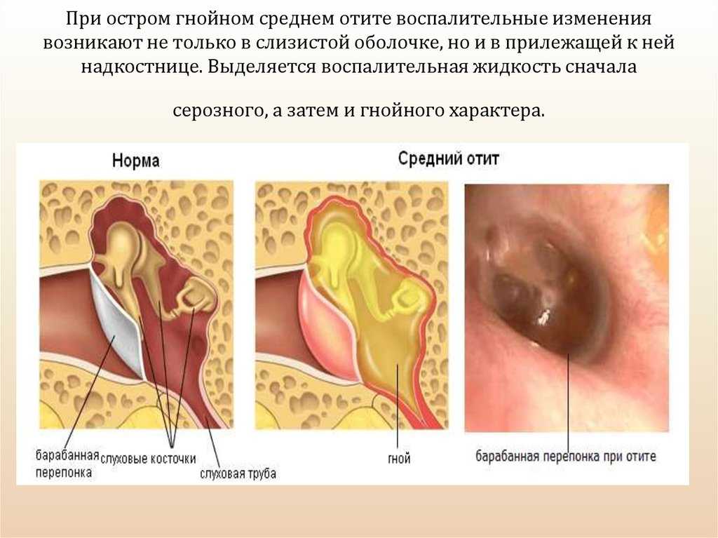Особенности и лечение катарального отита — лор центр