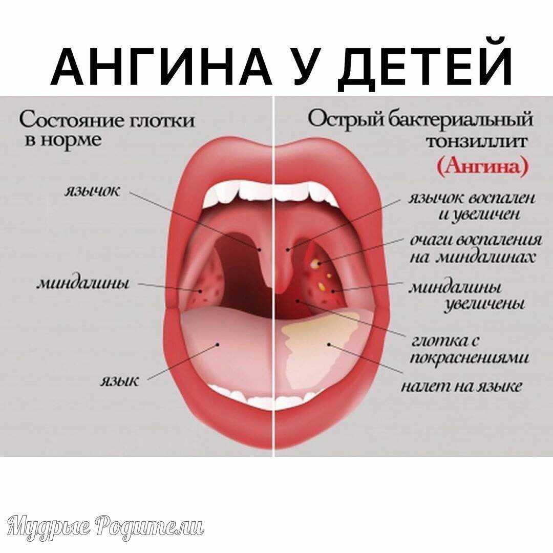 Острый тонзиллит у детей — симптомы и лечение ангины у детей