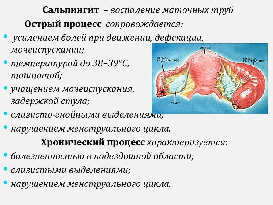 Лечение воспаления придатков у женщин