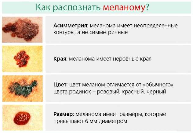 Нейрофиброматоз у детей - симптомы болезни, профилактика и лечение нейрофиброматоза у детей, причины заболевания и его диагностика на eurolab
