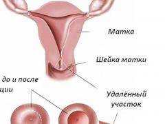 Аденомиоз