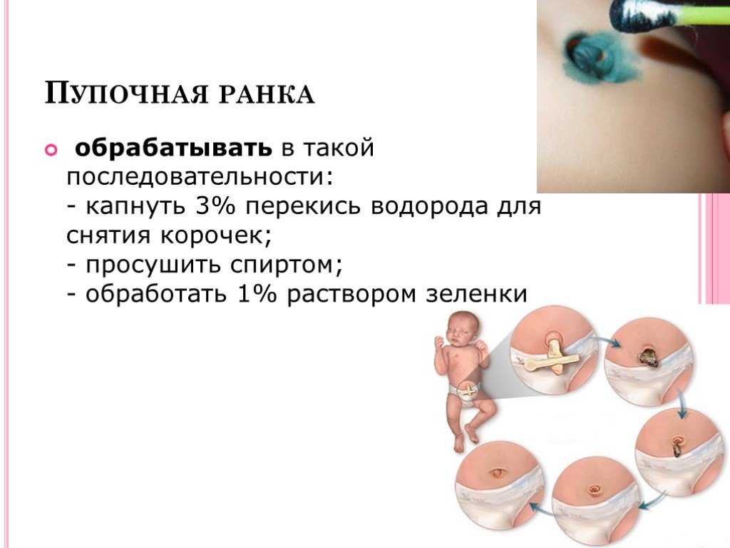 Мокнет пупок у новорожденного (лечение и профилактика)