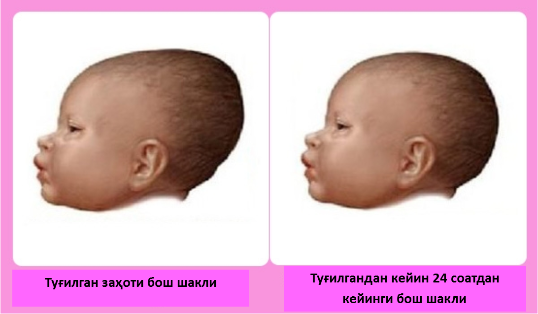 Комаровский о кривошее у новорожденных: лечение и признаки кривошеи у ребенка