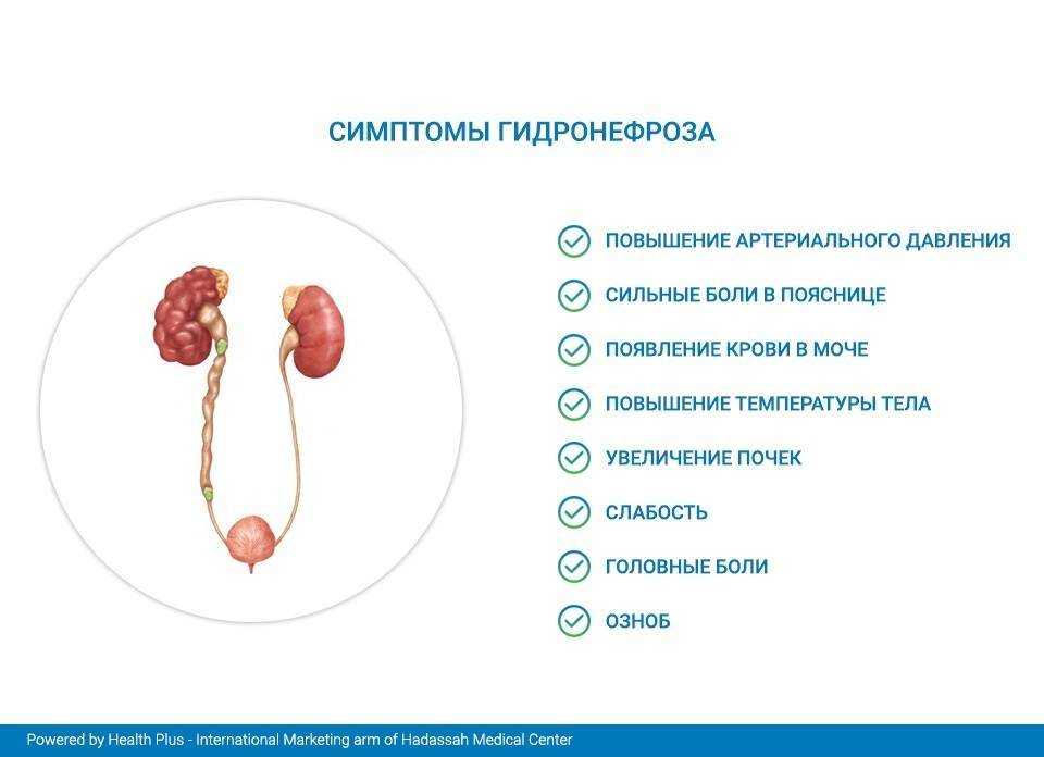 Гидронефроз клиническая картина