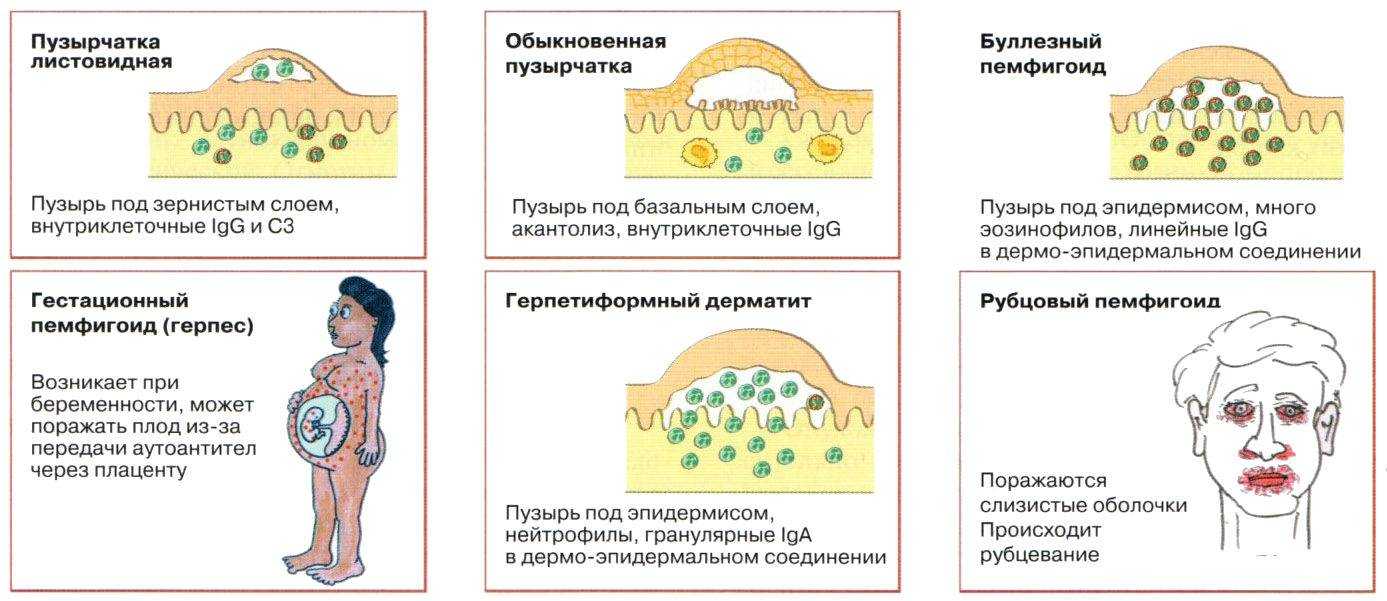Пузырчатка эпидемическая новорожденных
