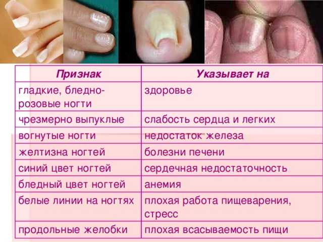 Черные полоски на ногтях рук - причины и лечение