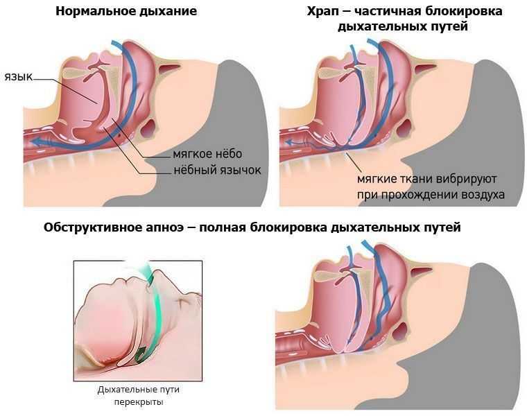Детское апноэ сна