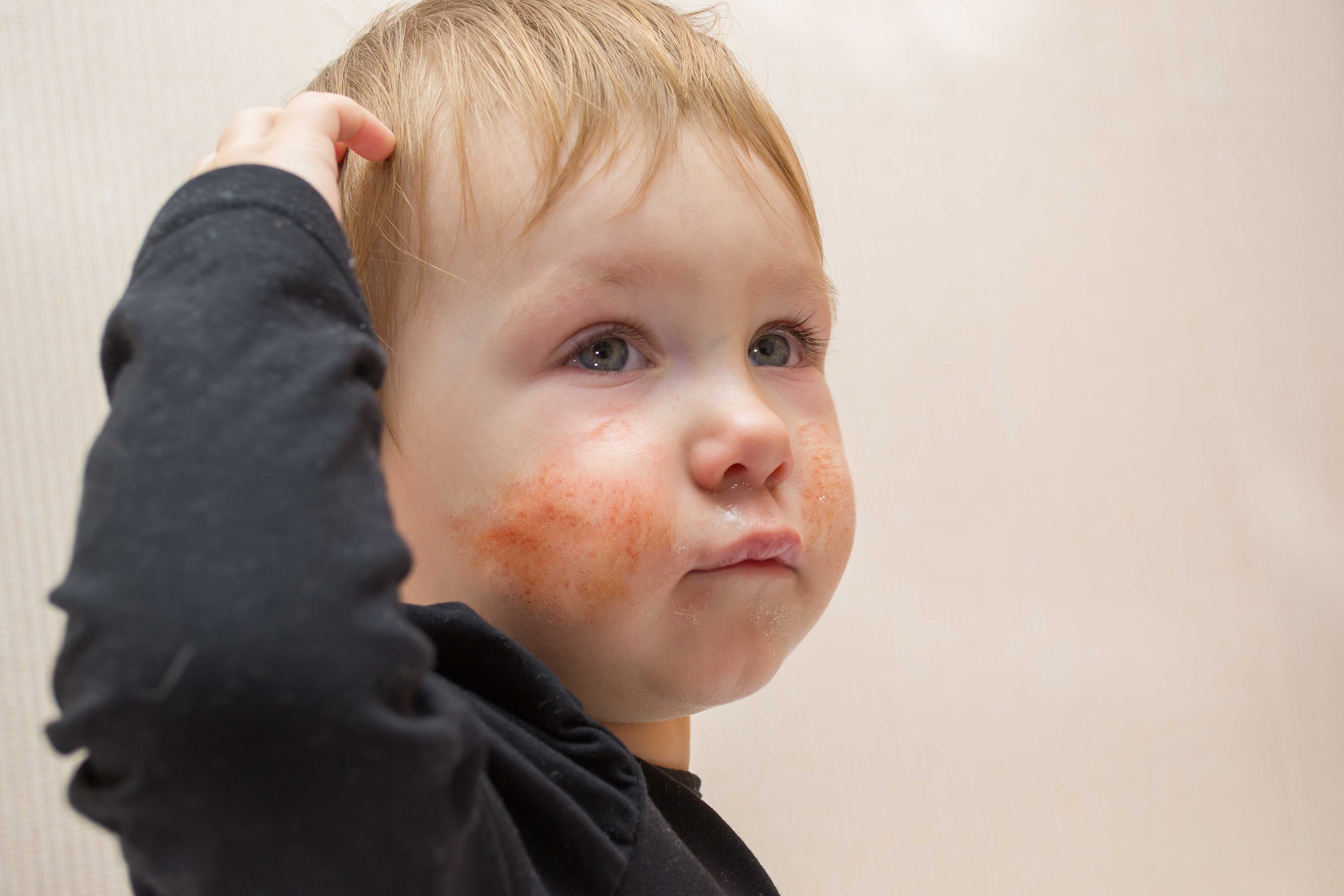 У ребенка болит щека. Атопический дерматит у детей.
