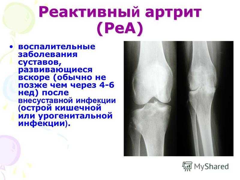 Лечение воспаления тазобедренного сустава у ребенка, симптомы и причины детского артрита