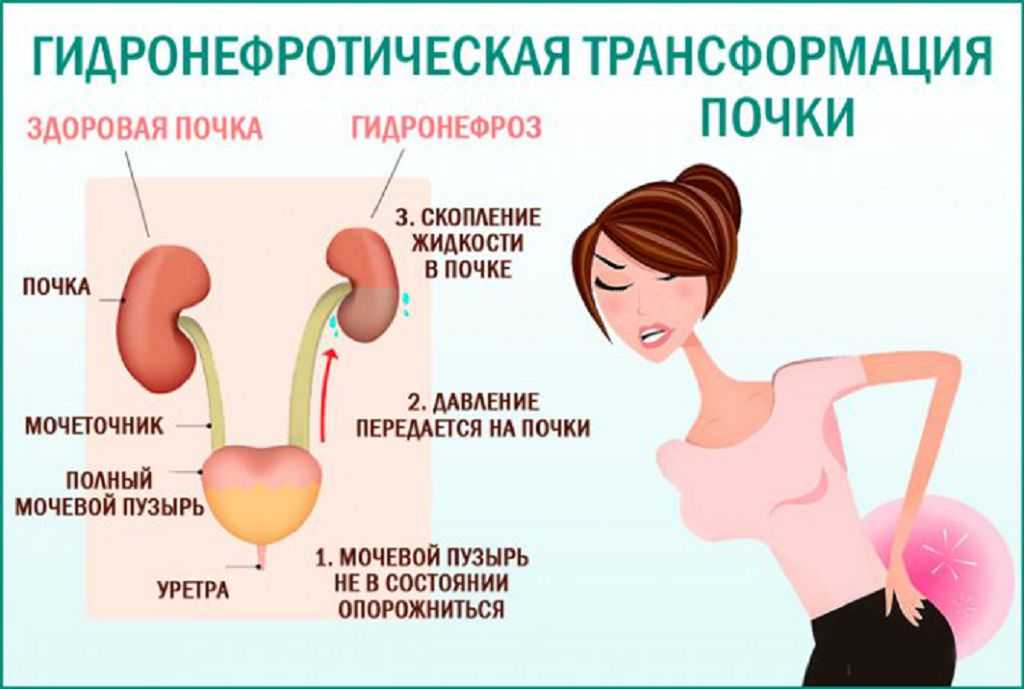 Что означает термин плавающая почка. Гидронефроз трансформация почки. Гидронефроз левой почки 2ст. Симптомы гидронефротической трансформации почки. Гидроуретеронефротическая трансформация почки.