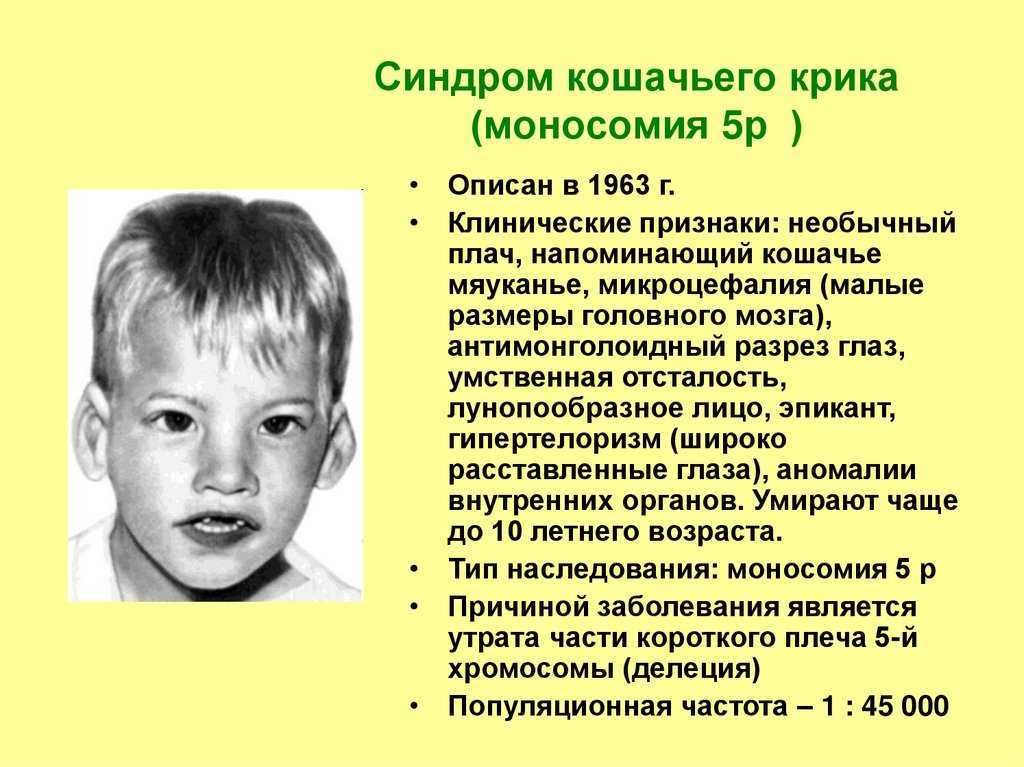 Синдром кошачьего крика — лежена