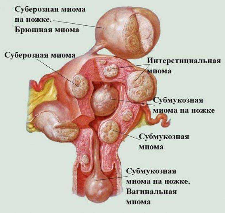 Миома матки
