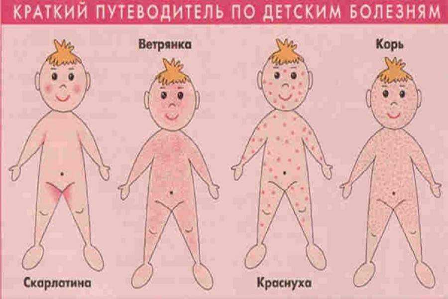 Как выглядит у ребенка ветрянка: фото начальной стадии и симптомы