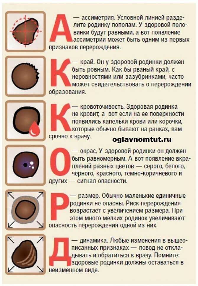 Когда у детей появляются родинки?