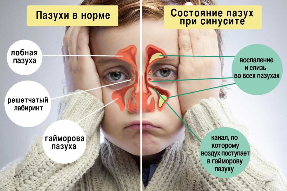 Болит голова и кровь из носа