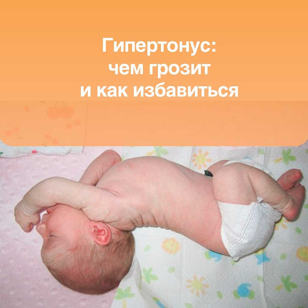 Врожденный гипертонус