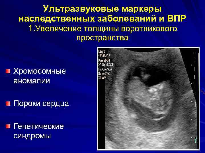 Генетические причины бесплодия - хромосомные аберрации при бесплодии, делеции y-хромосомы. часть 2 | университетская клиника