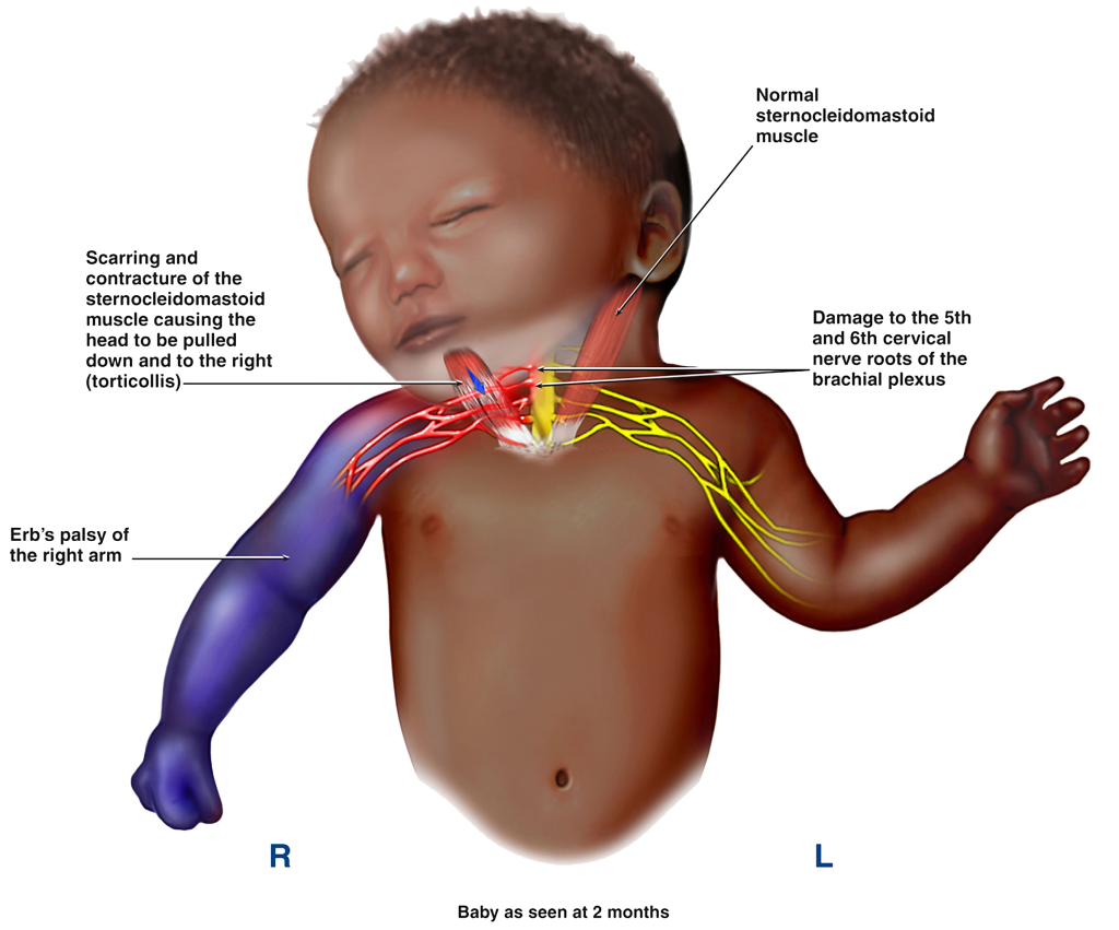 Парез дюшена эрба. Травмы плечевого сплетения у новорожденных.
