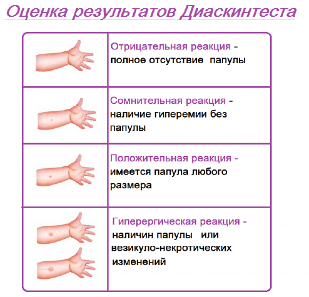Можно ли мочить прививку манту: сколько дней нельзя мыться, что будет, если намочить