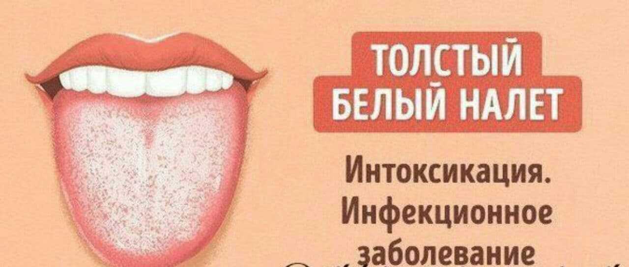 Молочница у ребенка во рту: чем лечить в домашних условиях