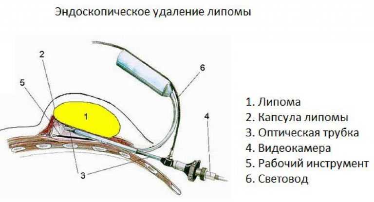 Жировики у новорожденных детей (грудничков) на лице и носу: что такое, симптомы, причины, лечение, что делать