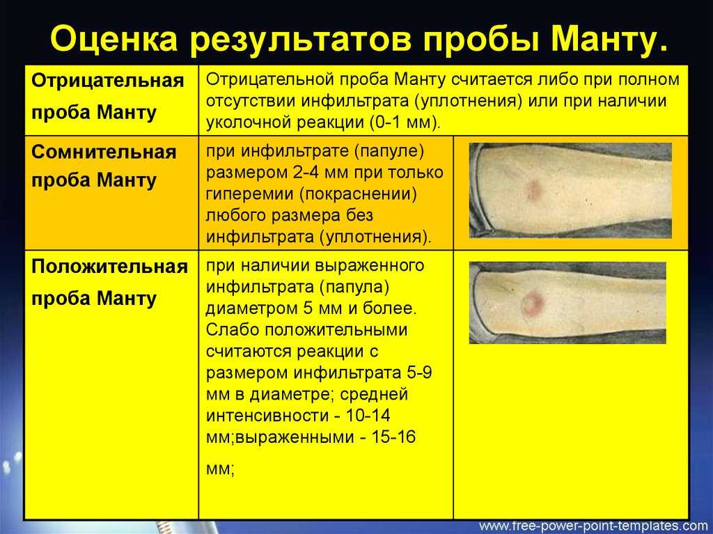 Можно ли мочить манту и что будет если все таки намочили? | s-voi.ru