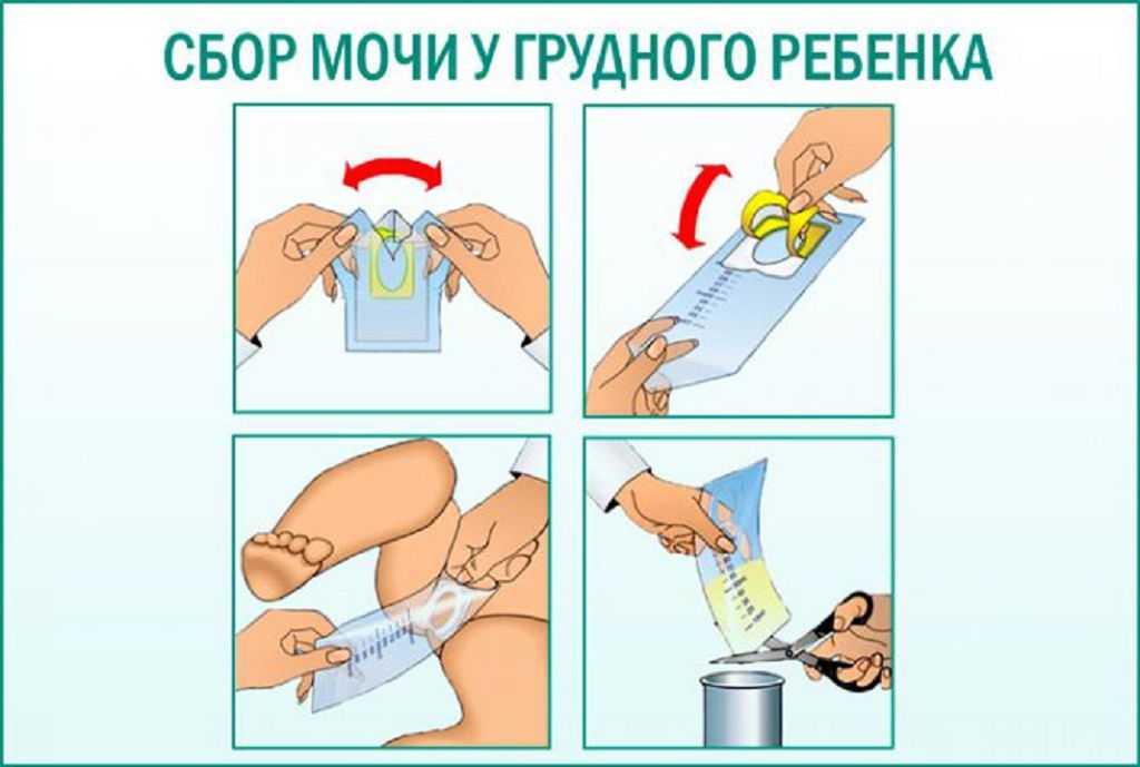 Как правильно сдавать анализ мочи