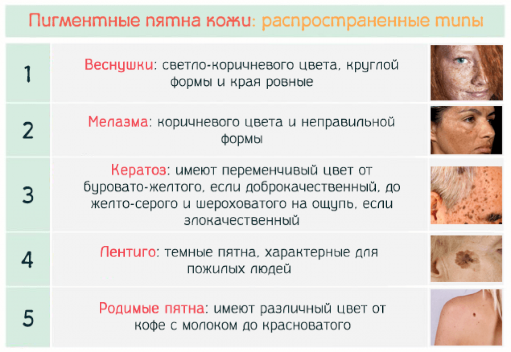 Монгольское пятно у новорожденного: что означает, причины появления, лечение
