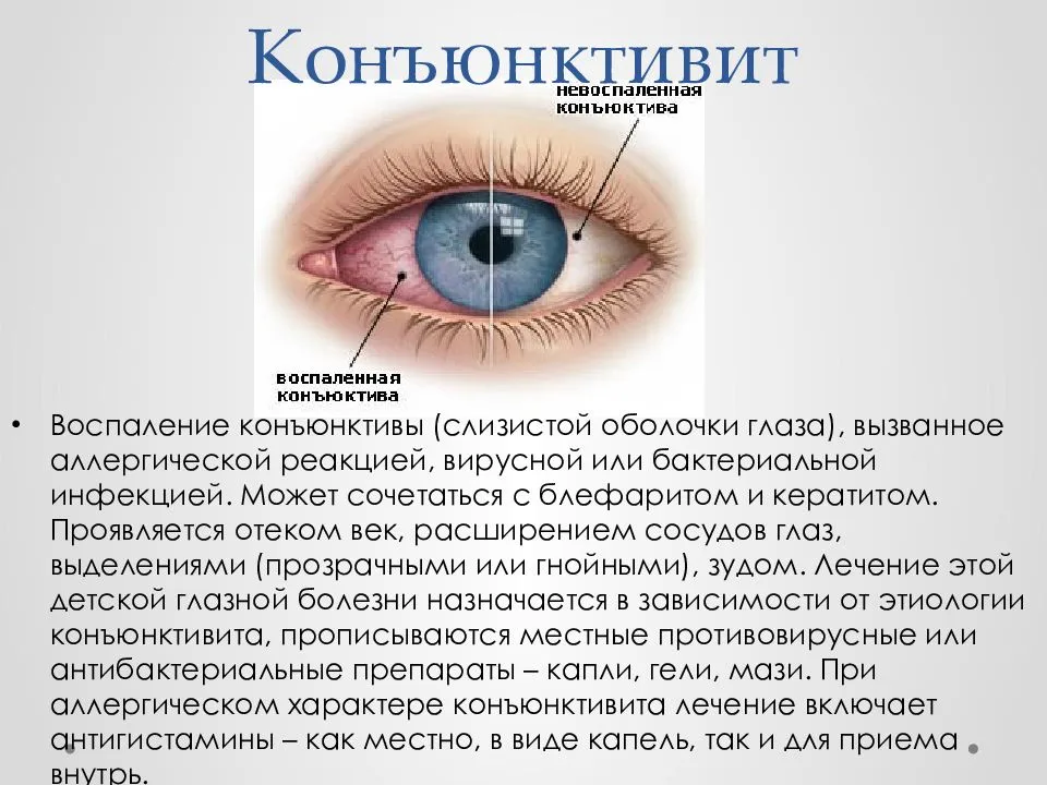 Конъюнктивит: симптомы и лечение бактериальных, вирусных, аллергических конъюнктивитов