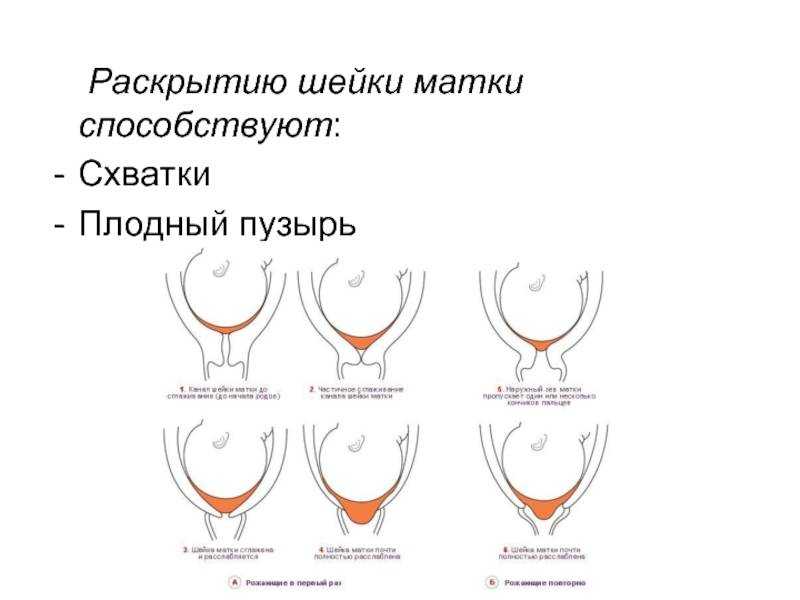 Как ускорить раскрытие шейки матки при родах: 12 шагов